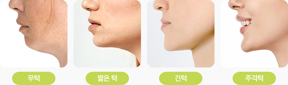 사각턱 수술 3D CT 얼굴뼈 입체적 분석 증상별 맞춤 수술계획 신경선 위치 정확한 절제부위 파악