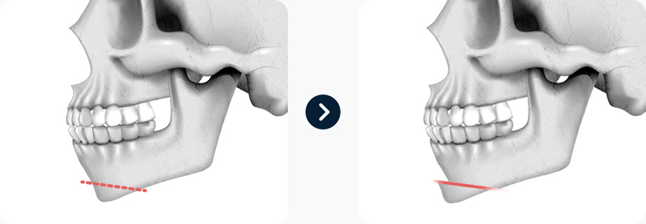 짧은코 코성형 전후사진