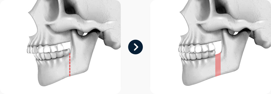 짧은코 코성형 전후사진