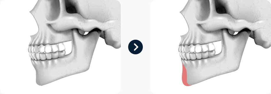 짧은코 코성형 전후사진