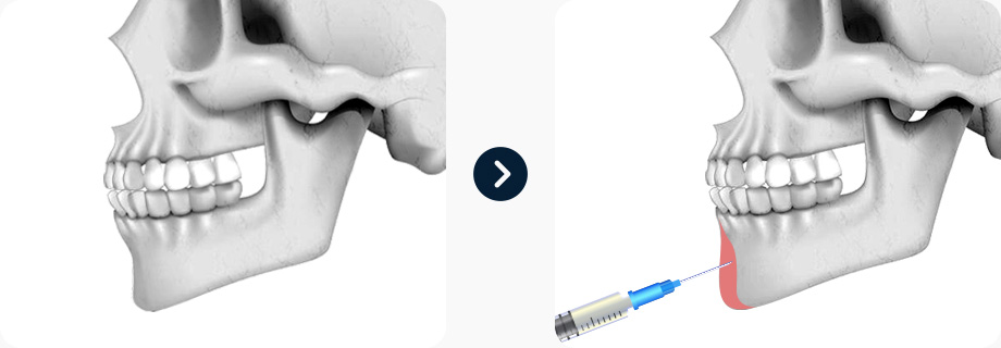 짧은코 코성형 전후사진