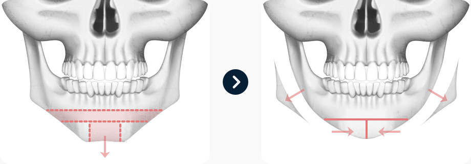 짧은코 코성형 전후사진