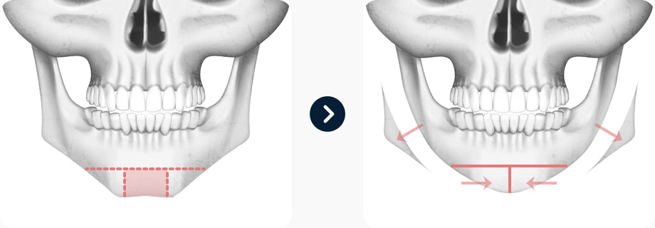 짧은코 코성형 전후사진