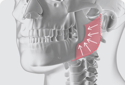사각턱수술 방법 교근 축소술