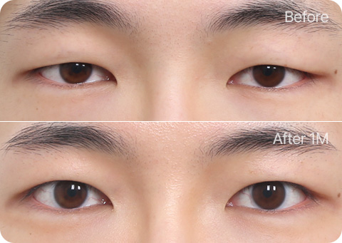 원더풀 무쌍눈매교정 자연유착