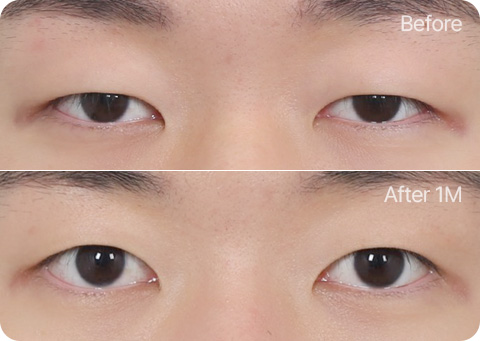 원더풀 무쌍눈매교정 부분절개 눈위지방제거