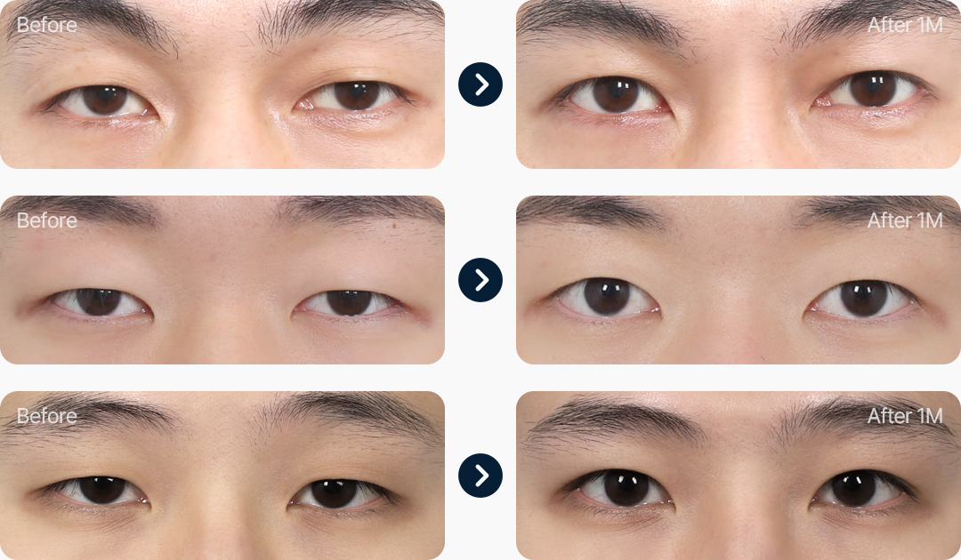 비절개 눈매교정 남자무쌍눈매교정 전후사진