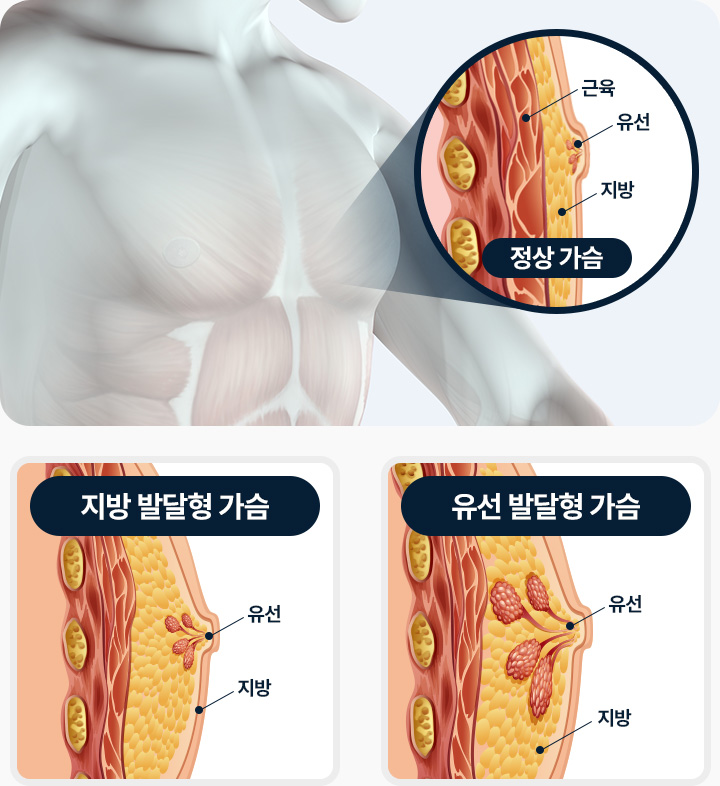 남자여유증증상 여유증원인 지방 발달형 가슴 유선 발달형 가슴