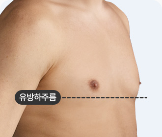 여유증 1등급 유방하주름