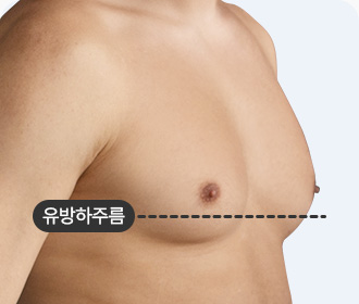 여유증 2-a등급 유방하주름