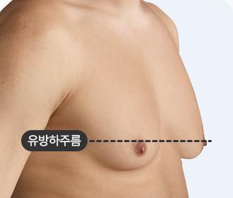 여유증 3등급 유방하주름