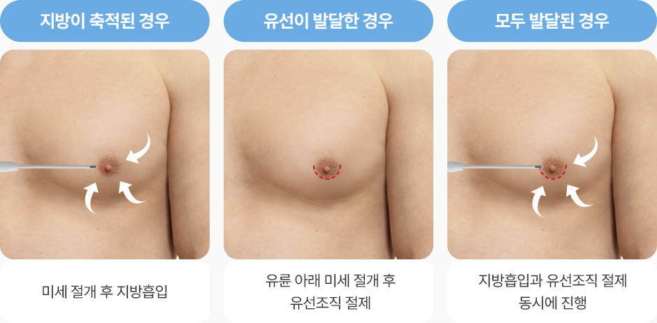지방 축적 미세절개 지방흡입 유선 발달 유륜 아래 미세절개 유선조직 절제 모두 발달 시 지방흡입 유선조직 절제 동시 진행