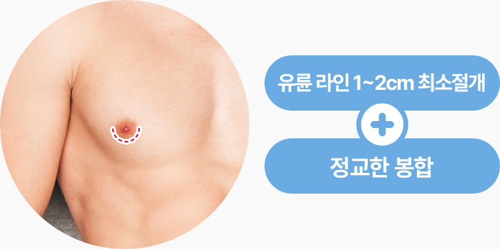 유륜라인 1cm 2cm 최소절개 정교한 봉합