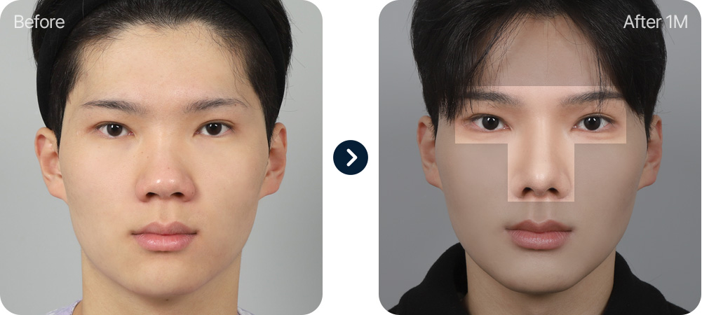 남자코성형 전후사진 T존