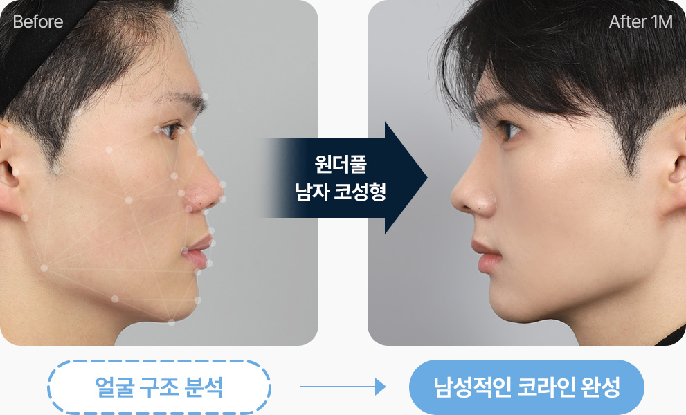 원더풀 남자코성형 얼굴 구조 분석 남성적인 코라인 완성