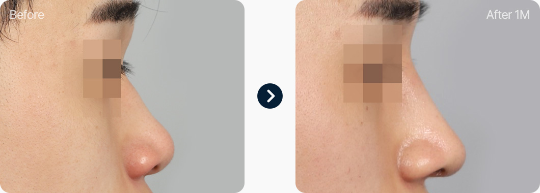 짧은코 성형 전후사진