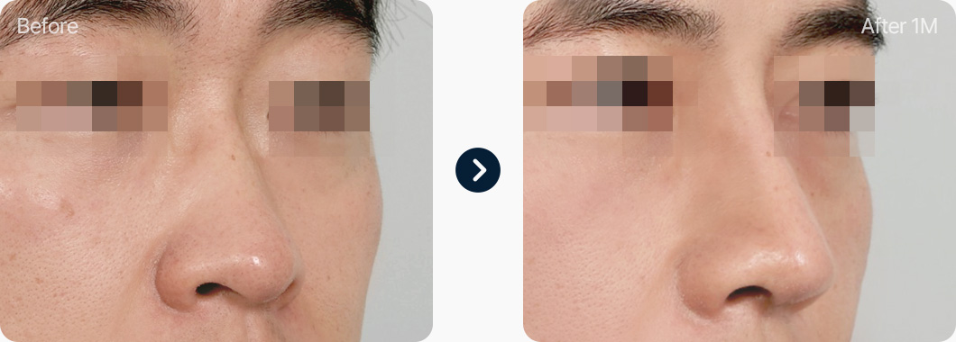 낮은코 성형 전후사진