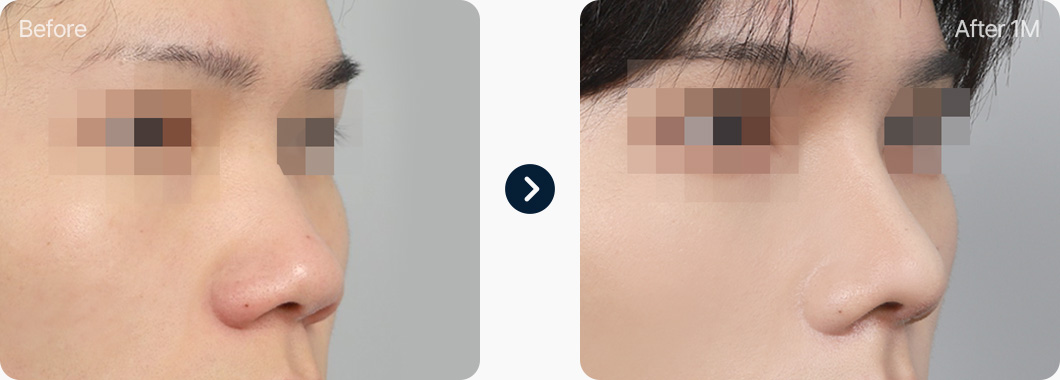 들창코 성형 전후사진