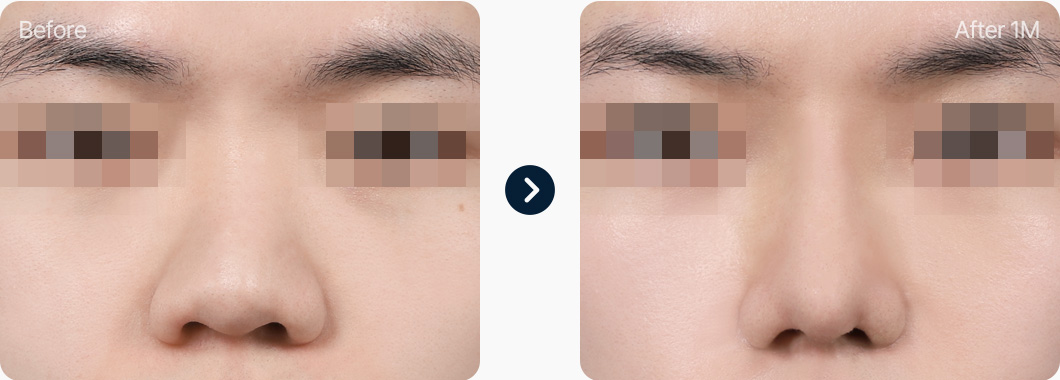 복코 성형 전후사진