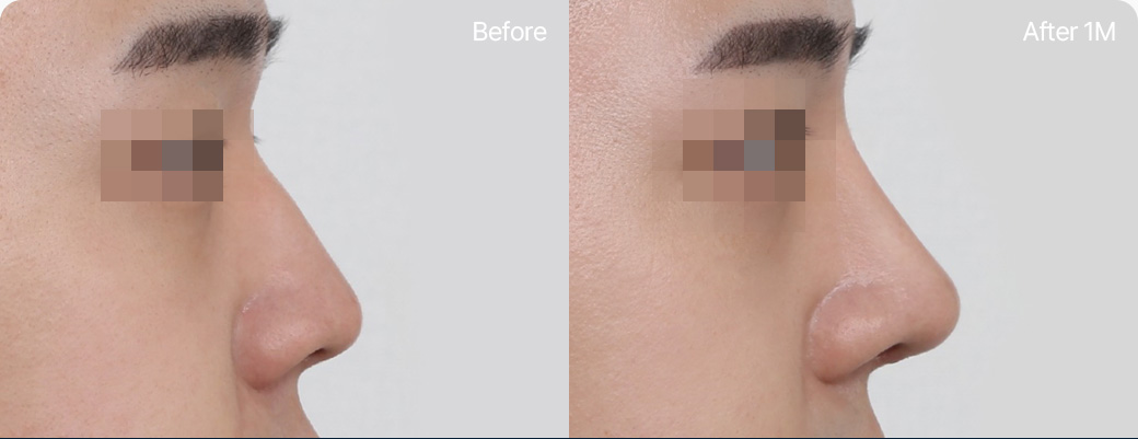 기본코성형 귀연골 전후사진