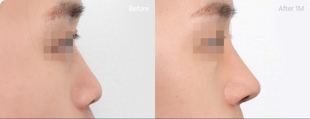 기본코성형 기증늑연골 전후사진