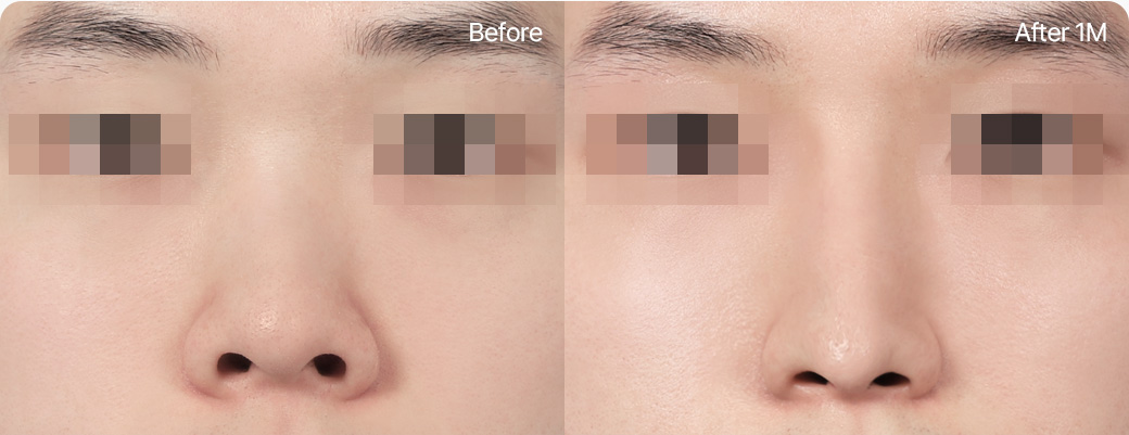 기본코성형 짧은코연장 전후사진