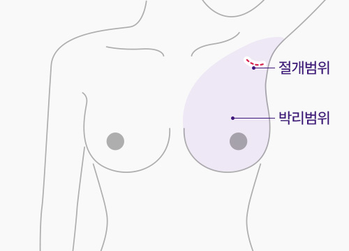 겨드랑이 절개