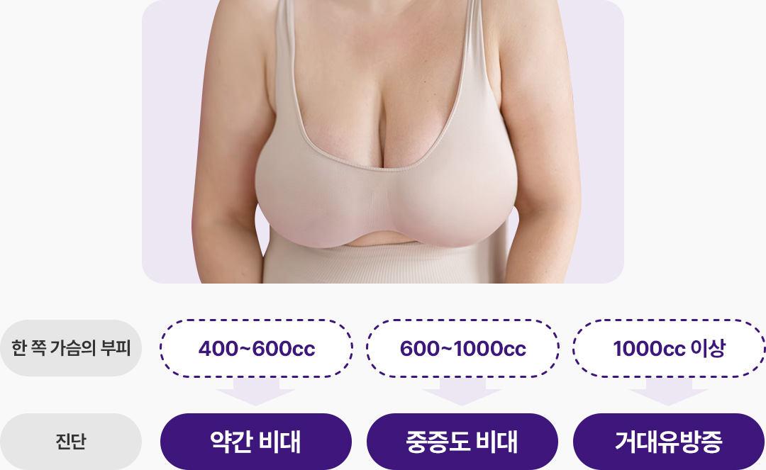 유방비대증 한쪽가슴부피 400에서 600cc 약간비대 600에서 1000cc 중증도비대 1000cc이상 거대유방증
