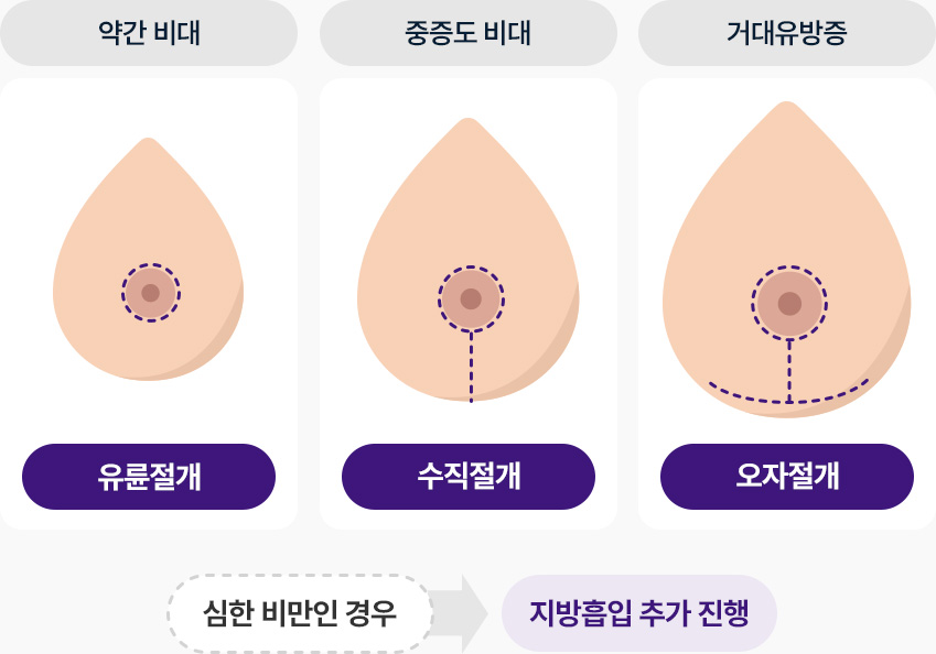 가슴축소 약간비대 유륜절개 중증도비대 수직절개 거대유방증 오자절개 심한 비만 지방흡입 추가진행