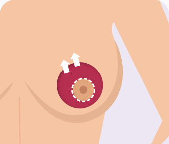 가슴축소 유륜절개 유두를 당겨 올림