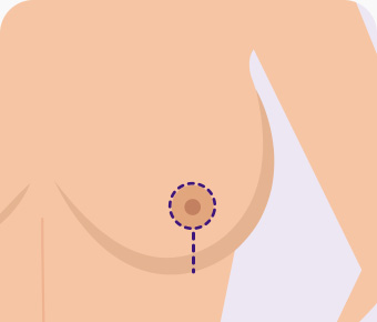 가슴축소 수직절개 유륜둘레와 수직아래로 절개