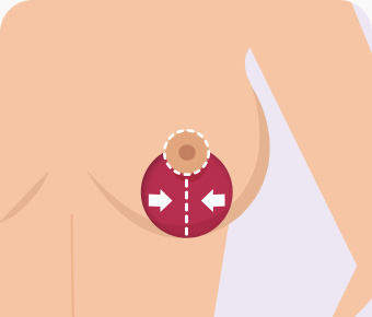 가슴축소 수직절개 처진 유선과 피부조직 절제