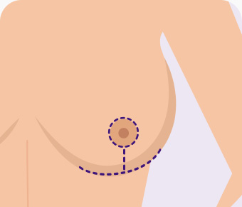 가슴축소 오자절개 유륜둘레와 가슴 밑주름을 따라 절개