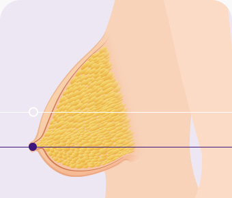 가슴축소 지방흡입 원하는 가슴모양으로 디자인