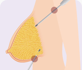 가슴축소 지방흡입 미세절개로 지방흡입
