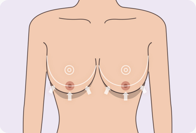 가슴거상 유방하수