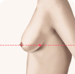 가슴거상 유방하수 등급 1급