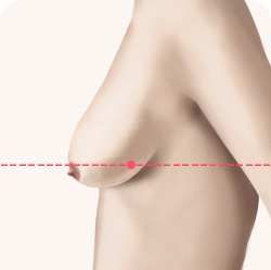 가슴거상 유방하수 등급 2급