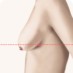 가슴거상 유방하수 등급 3급