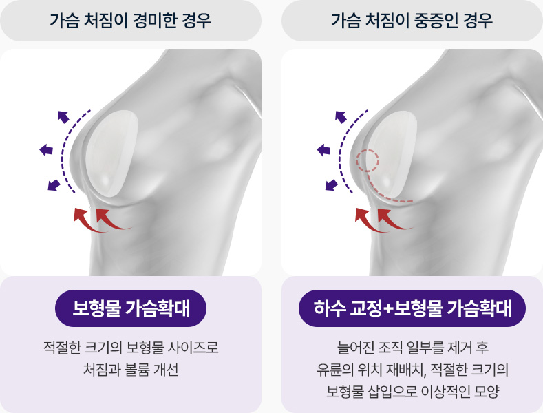 가슴거상 방법 가슴처침이 경미 보형물 가슴확대 적절한 보형물사이즈로 처짐과 볼륨개선 가슴처짐이 중증인 경우 하수교정 보형물가슴확대 늘어진 조직 제거 유륜 위치 재배치 적절한 보형물 삽입