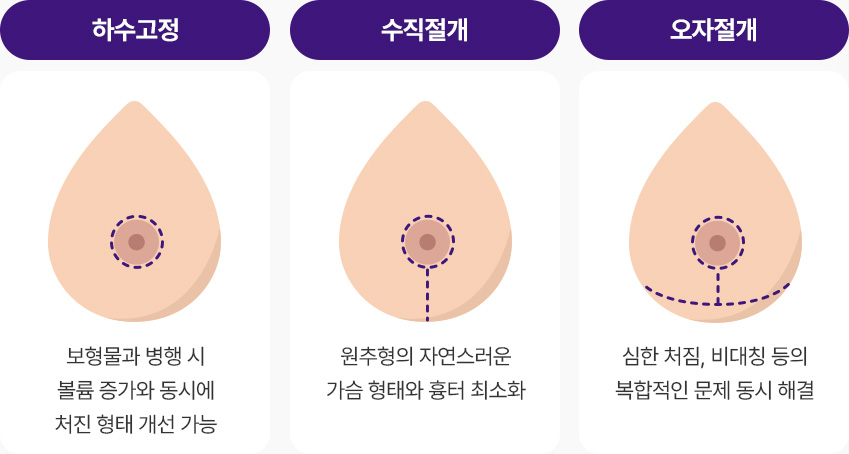 하수교정 보형물 삽입 병행 볼륨증가 처진형태 개선 가능 수직절개 원추형의 자연스러운 가슴형태 흉터 최소화 오자절개 심한처짐 비대칭 등 복합적인 문제 동시해결