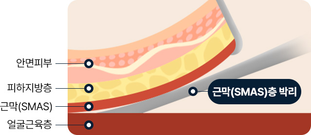 안면거상 안면피부 피하지방층 근막 얼굴근육층 근막층 박리