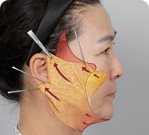 안면거상 수술방법 피부 지방 근막층을 각각 박리 유지인대 절제