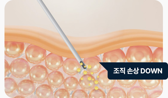 얼굴지방이식 특수 미세캐뉼라 조직 손상 최소화
