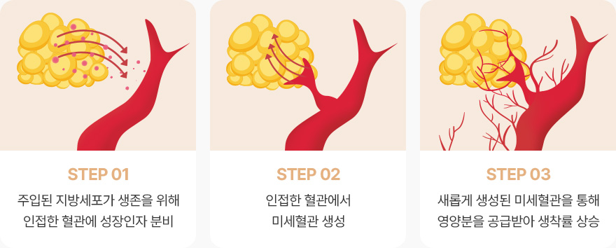 얼굴지방이식 생착률 상승 step 주입된 지방세포가 생존을 위해 인접한 혈관 성장인자분비 인접한 혈관에서 미세혈관 생성 생성된 미세혈관을 통해 영양분을 공급받아 생착률 상승
