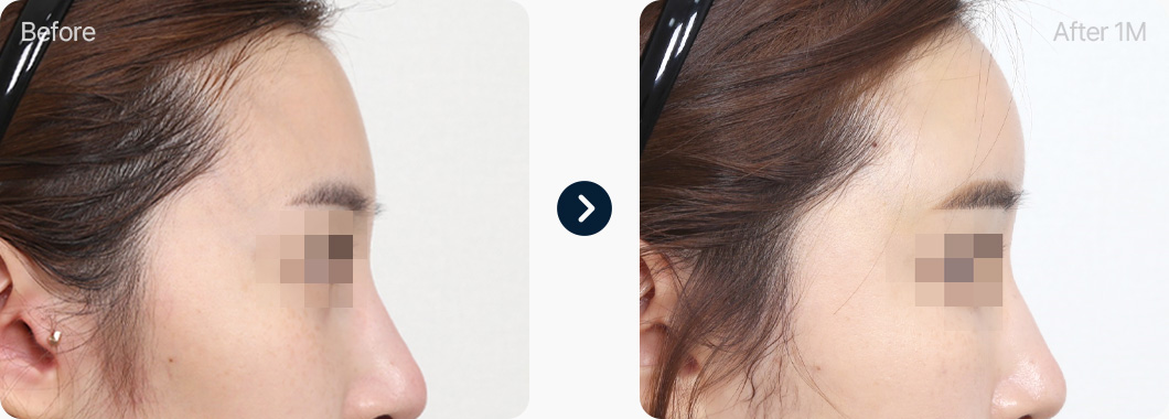 얼굴지방이식 전후사진 얼굴지방이식후기 이마 지방이식 전후