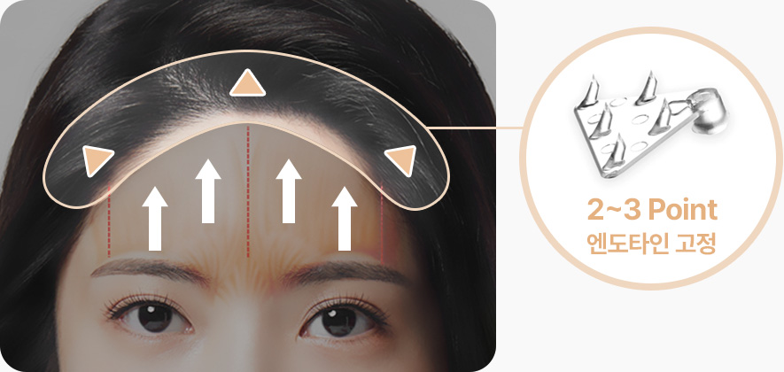 이마거상 정품 엔도타인 2개 3개 포인트 엔도타인고정