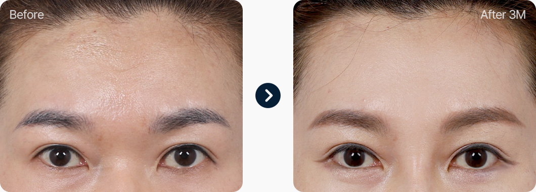 이마거상 전후사진 이마거상후기