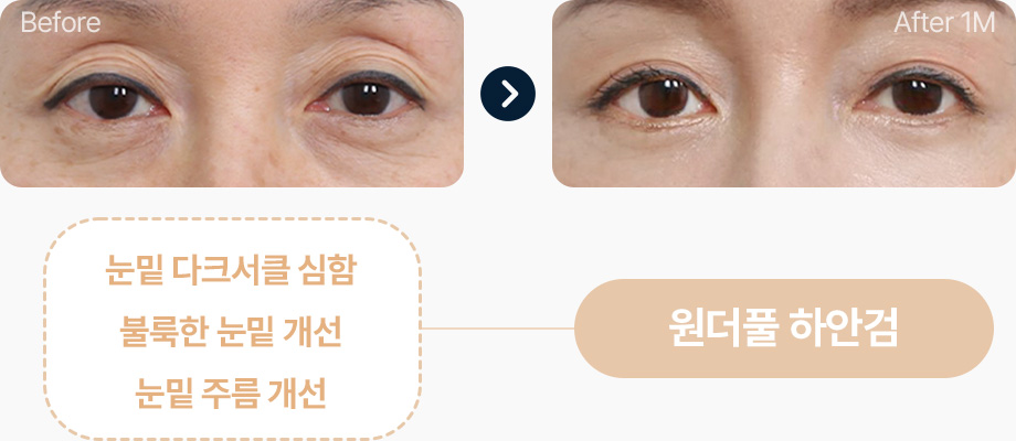 하안검 전후사진 하안검 수술후기 눈밑 다크서클 불룩한 눈밑 눈밑주름 개선 원더풀 하안검
