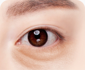 눈밑 처짐 피부상태 정밀진단 개인 맞춤 디자인 계획